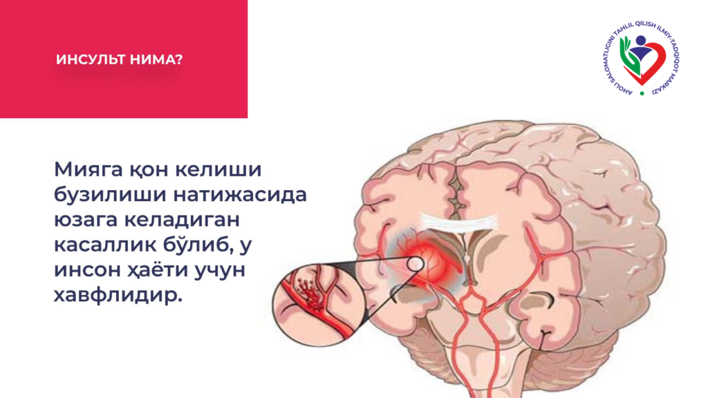 03-what-is-stroke